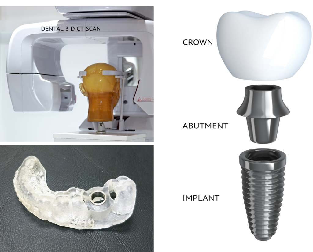 Dental Implant 3D Scan