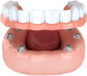 Implants Denture Retention